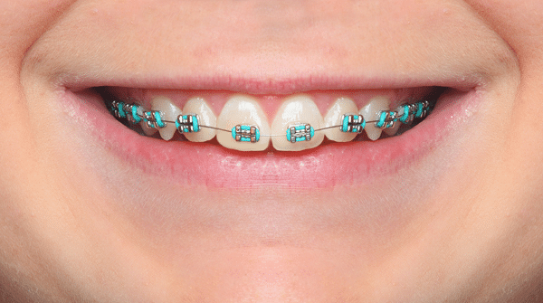 Foods You Can Eat With Braces | Northeastern Braces